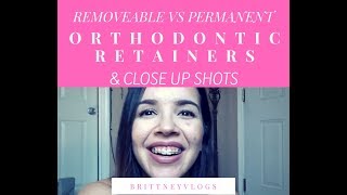 PROS amp CONS CLOSE UPs ORTHODONTIC RETAINERS BRACES UPDATE [upl. by Gusti]