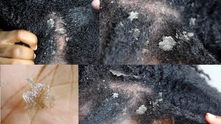 My Seborrheic Dermatitis my scalp up close [upl. by Argile602]