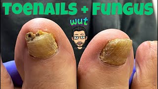 HOW TO CUT THICK TOENAILS WITH FUNGUS [upl. by Reisman]