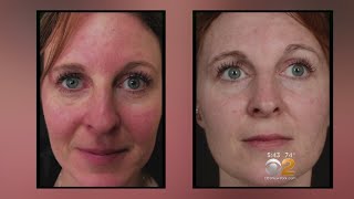 Health Watch New Laser Treatment For Rosacea [upl. by Venita]