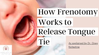 How Frenotomy Works to Release Tongue Tie [upl. by Aletta347]