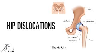 Hip dislocation [upl. by Arvell]