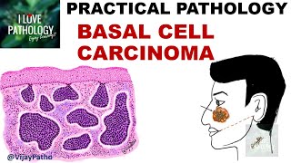 BASAL CELL CARCINOMA Clinical features amp Morphology [upl. by Peh480]