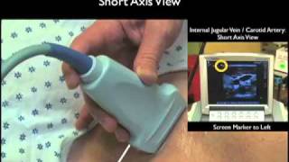 How To Ultrasound Guidance for Central Venous Access Part 1 Case Study [upl. by Stubstad]