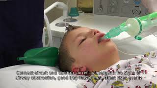 Paediatric Anaesthetics Chapter 2  LMA insertion 1 [upl. by Yanffit157]