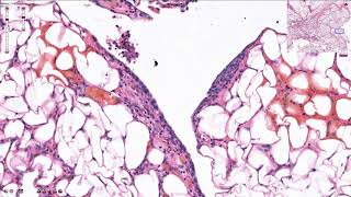 Peritoneal Carcinomatosis  Histopathology [upl. by Ajiam]