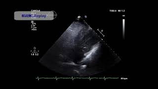 PlatypneaOrthodeoxia Syndrome [upl. by Novad]