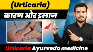 Urticaria दाद खाज खुजिलीशरीर पर लाल निशान क्यों होता है कारणampइलाजUrticaria Ayurveda medicine ep453 [upl. by Tish]