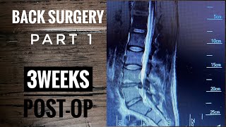 Back Surgery Laminectomy L4L5 Recovery part 1 [upl. by Alrahs]