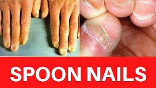 SPOON NAILS  Koilonychia Causes Treatment Symptoms Iron deficiency Anemia Cure Prevention [upl. by Valaree916]