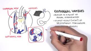 Upper GI Bleed Causes Overview [upl. by Zeke]