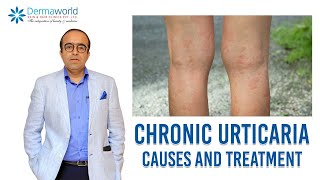 Chronic Urticaria  causes and treatment  Chronic Hives  Dr Rohit Batra [upl. by Karyn]