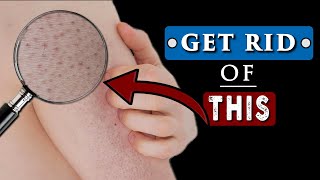 How to GET RID of WHITE BUMPS on ARMS  KERATOSIS PILARIS [upl. by Ailisec725]