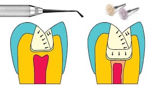 Manipulación de resina dental [upl. by Walt]