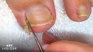 How Toenails Are Professionally Cleaned [upl. by Airetak]