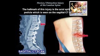 Flexion Distraction Injury Of The lumbar Spine  Everything You Need To Know  Dr Nabil Ebraheim [upl. by Aredna]