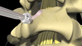 Low Back Pain Lumbar Laminectomy Surgery [upl. by Danice]