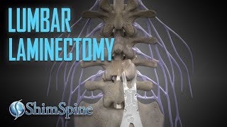 Lumbar Laminectomy [upl. by Akvir867]