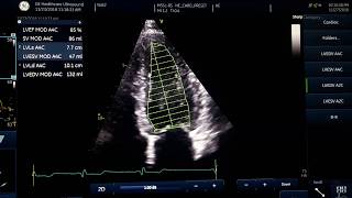 Ejection fraction measurement [upl. by Jaban536]