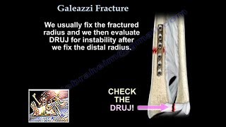 Galeazzi Fracture  Everything You Need To Know  Dr Nabil Ebraheim [upl. by Seluj702]