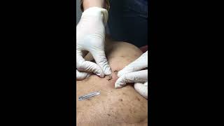 Squeeze amp Pop Cyst 1 [upl. by Pacien834]