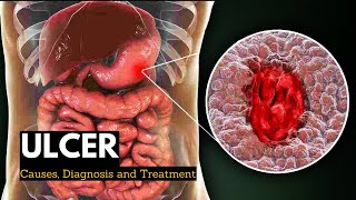 Ulcer Causes Signs and Symptoms Diagnosis and Treatment [upl. by Eugenle]