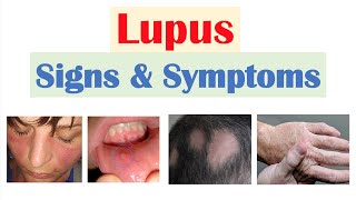 Systemic Lupus Erythematosus  SLE  Pathophysiology Diagnosis Diagnostic Criteria amp Management [upl. by Candace]