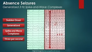 Absence Seizures EEG Findings [upl. by Nomaid]