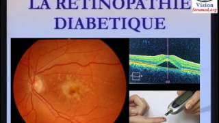 Rétinopathie diabétique définition physiopathologie Classification [upl. by Anits864]