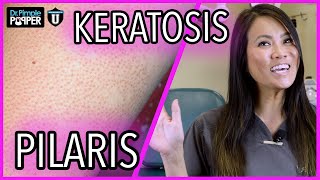 What Are These Bumps On My Skin  Keratosis Pilaris  with Dr Sandra Lee [upl. by Gothar]