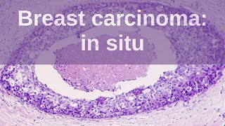 Short Review Invasive Lobular Carcinoma Breast  Histiocytoid Type [upl. by Hilten]