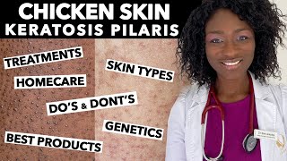 Keratosis Pilaris Chicken Skin  Treating Dry Bumpy Skin  Special Tips for Black Skin  Ask Doctor [upl. by Aynot]