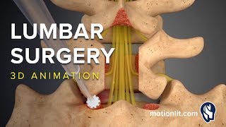 One week recovery laminectomy discectomy l4 l5 [upl. by Noffihc22]