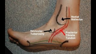 Posterior Tibial Tendinitis Evaluation with Paul Marquis PT [upl. by Irami]