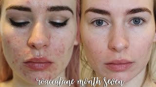 ROACCUTANE MONTH 7 Update  Side Effects [upl. by Arjan]