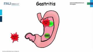 Innere Medizin ─ Gastritis [upl. by Mallorie]