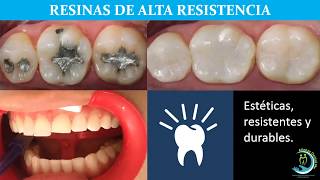 Resinas dentales de alta resistencia [upl. by Joh]