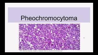 Pheochromocytoma [upl. by Norab]