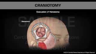 Craniotomy [upl. by Schrader296]