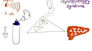 Myelodysplastic syndrome  Hematologic System Diseases  NCLEXRN  Khan Academy [upl. by Nerok]