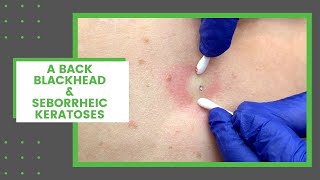 A Back Blackhead amp Seborrheic Keratoses  Dr Derm [upl. by Ahsienel]