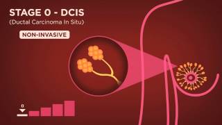 LUNG CANCER Part 1 Epidemiology Etiopathogenesis Precursor lesions amp Classification [upl. by Yebba426]