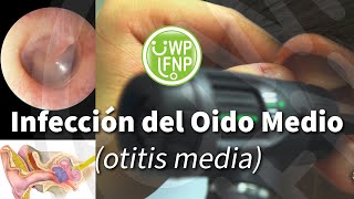 Infección del Oido Medio otitis media [upl. by Notlit]