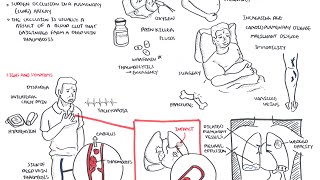 Pulmonary Embolism  Overview [upl. by Ahsikyt]