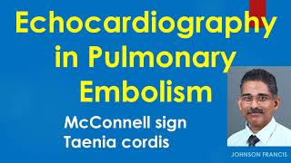 Echocardiography in Pulmonary Embolism [upl. by Cocks286]